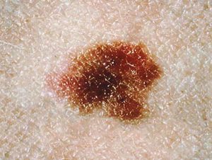 This dysplastic mole is more than 10 millimetres in diameter.