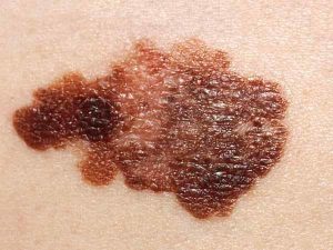 Melanoma. Asymmetric, uneven border, uneven colour, diameter is 20mm
