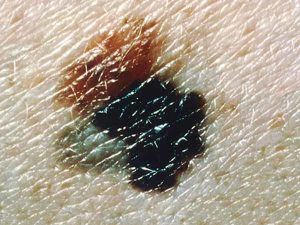 A blue-black melanoma that has irregular and scalloped borders. It has arisen from a dysplastic nevus (the pink-tan region at the upper left). The melanoma is about 12 millimetres wide.