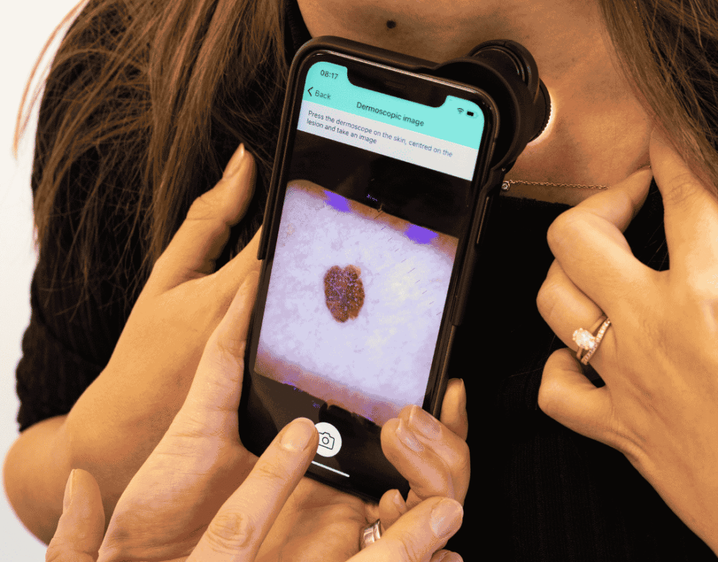 NHS England South East roll out AI skin cancer checks